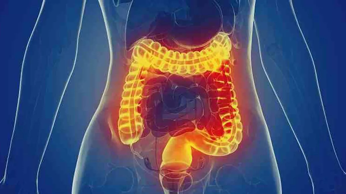 ¿Qué es la enfermedad diverticular?