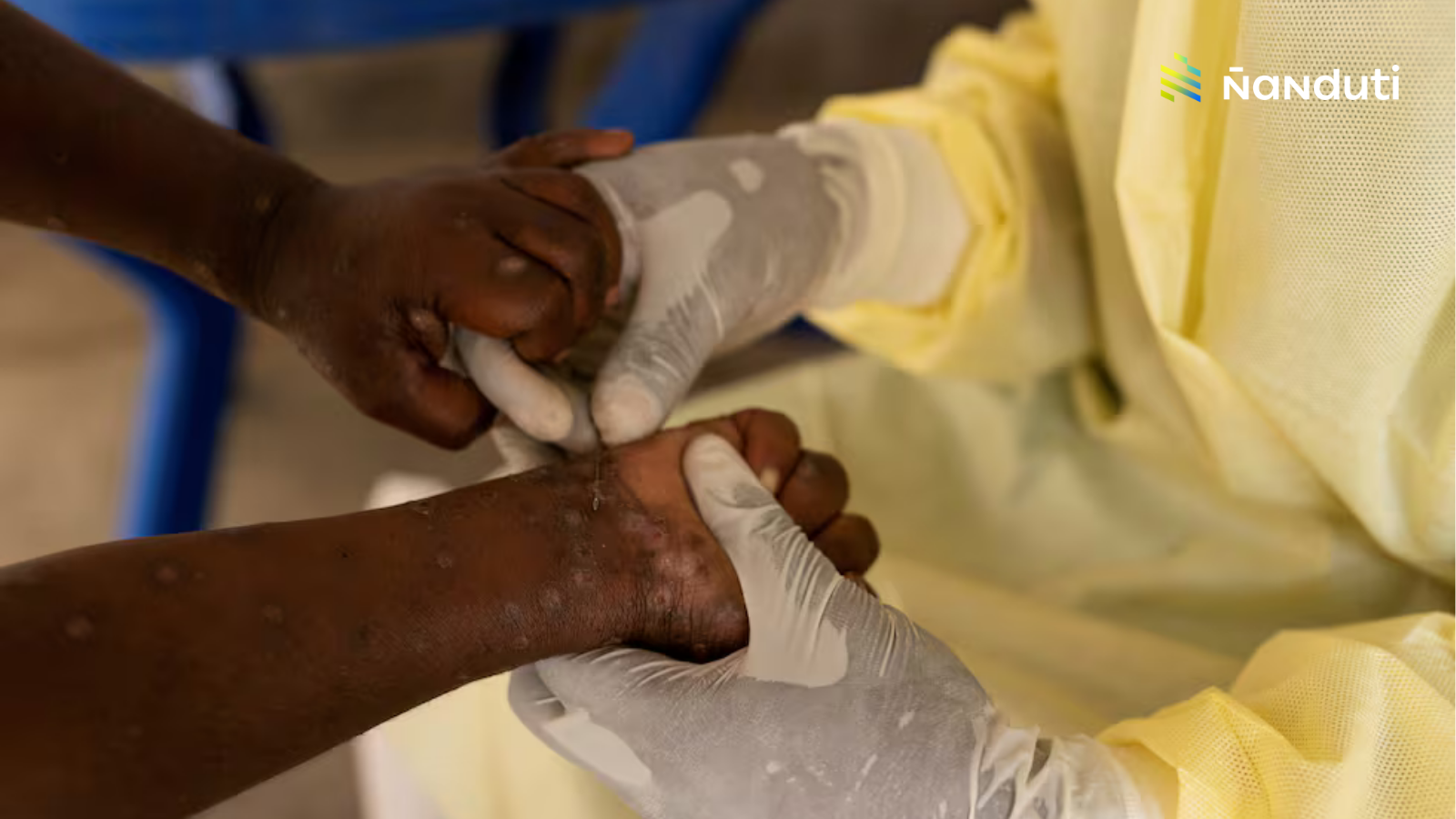 La OMS declara emergencia sanitaria por Mpox o viruela del mono