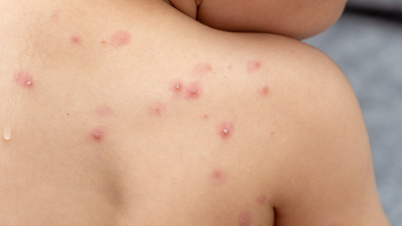 Viruela del mono: La prevención está en el “lavado de manos”, insta profesional