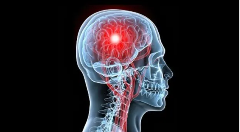 Accidentes cerebrovasculares: Una rápida atención puede salvar vidas