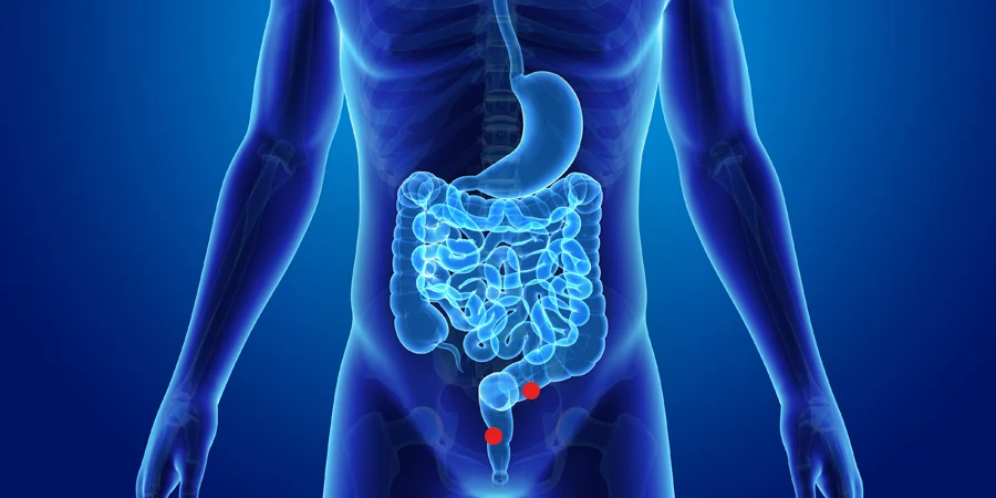 Día Mundial de Lucha Contra el Cáncer de Colon: Importancia de la prevención y el diagnóstico temprano
