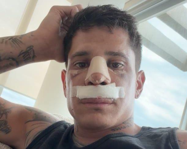 Iturbe y una exitosa cirugía de tabique nasal